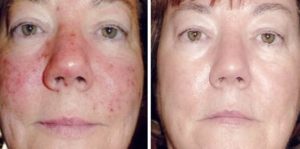 rosacea symptoms